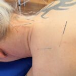 Dry needling
